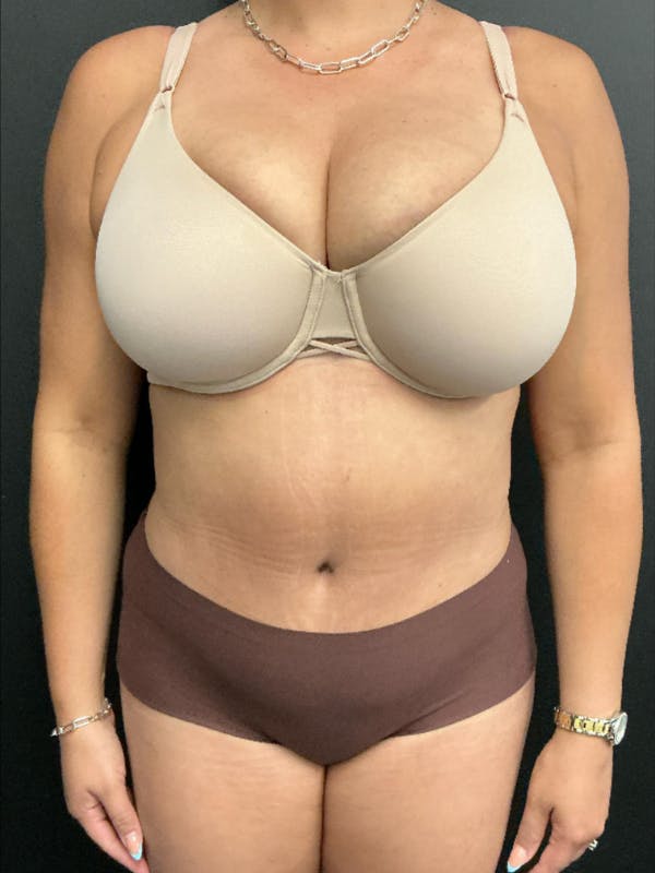 Tummy Tuck Before & After Gallery - Patient 123673 - Image 2
