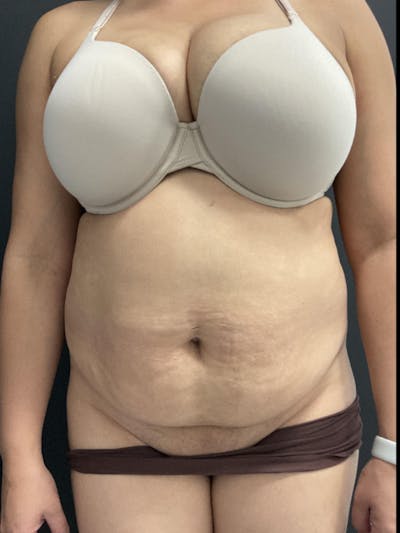 Tummy Tuck Before & After Gallery - Patient 123673 - Image 1