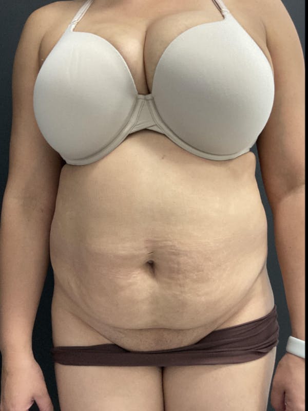 Tummy Tuck Before & After Gallery - Patient 123673 - Image 1
