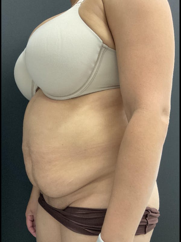 Tummy Tuck Before & After Gallery - Patient 123673 - Image 5