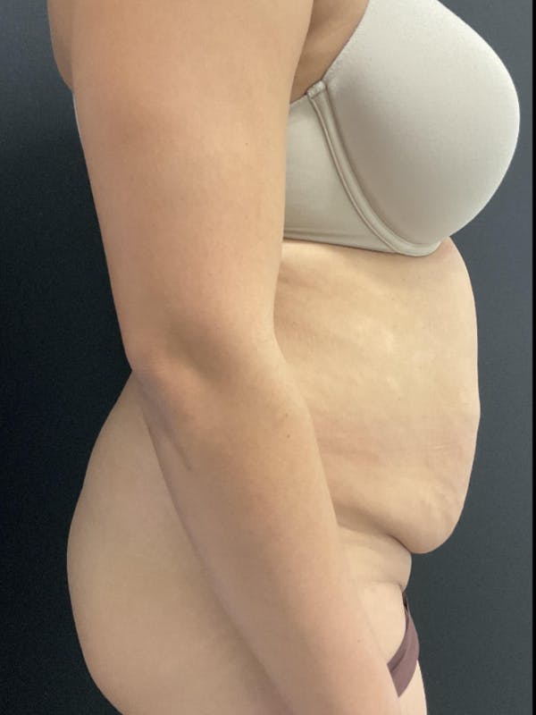 Tummy Tuck Before & After Gallery - Patient 123673 - Image 3