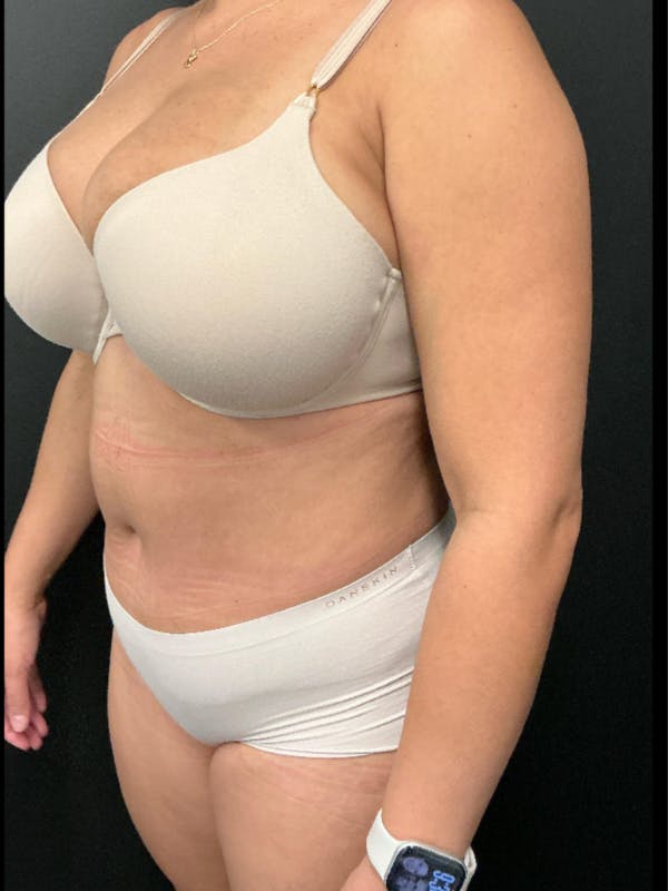 Tummy Tuck Before & After Gallery - Patient 123673 - Image 6