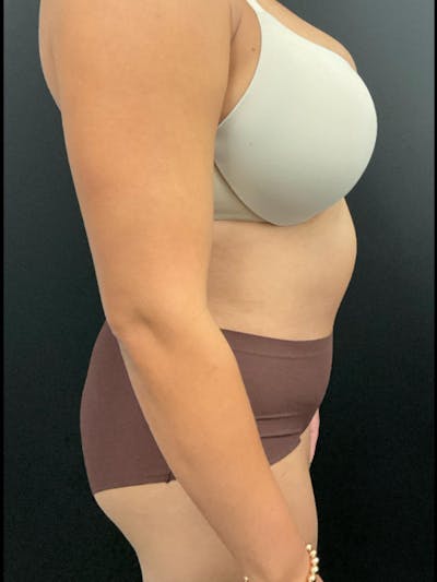 Tummy Tuck Before & After Gallery - Patient 123673 - Image 4