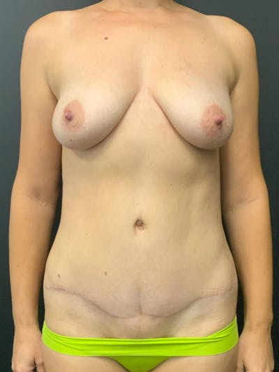 Tummy Tuck Before & After Gallery - Patient 142468 - Image 2