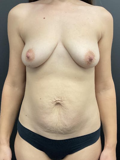 Tummy Tuck Before & After Gallery - Patient 142468 - Image 1
