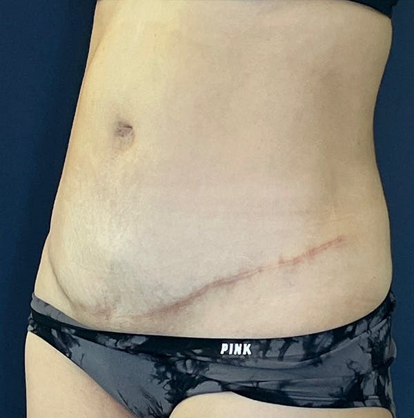 Tummy Tuck Before & After Gallery - Patient 583991 - Image 4