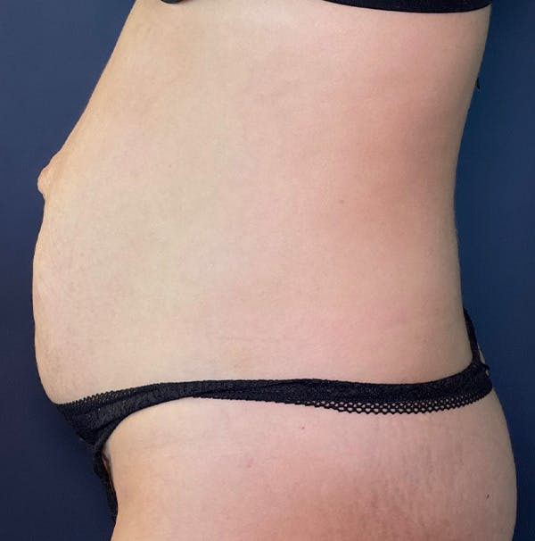 Tummy Tuck Before & After Gallery - Patient 583991 - Image 5