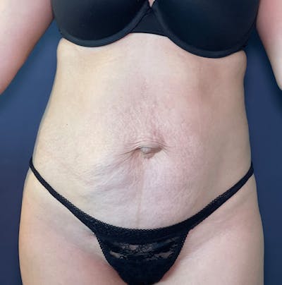 Tummy Tuck Before & After Gallery - Patient 583991 - Image 1