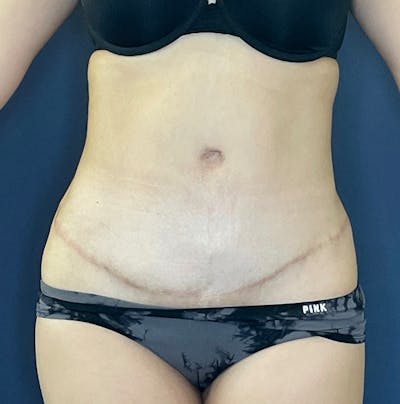 Tummy Tuck Before & After Gallery - Patient 583991 - Image 2