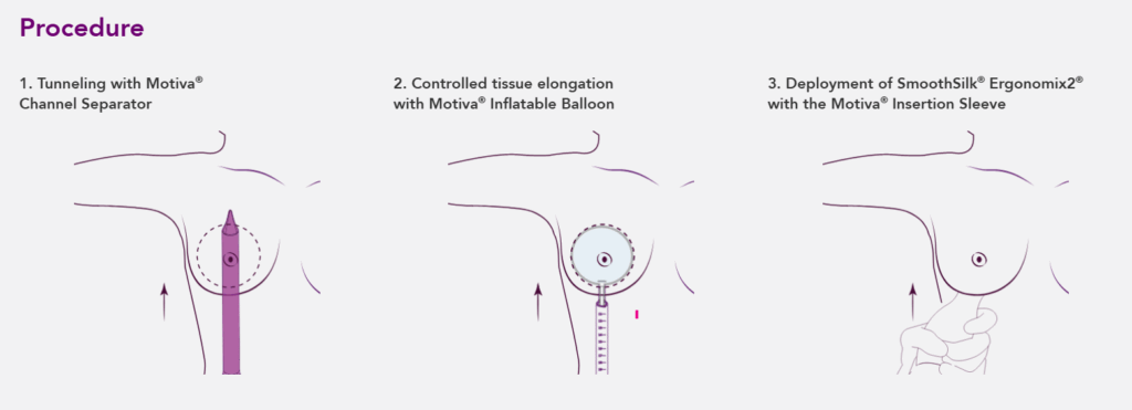 motiva breast implant procedure infographic