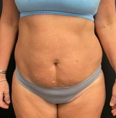 Tummy Tuck Before & After Gallery - Patient 402666 - Image 1