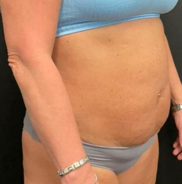 Tummy Tuck Before & After Gallery - Patient 402666 - Image 3