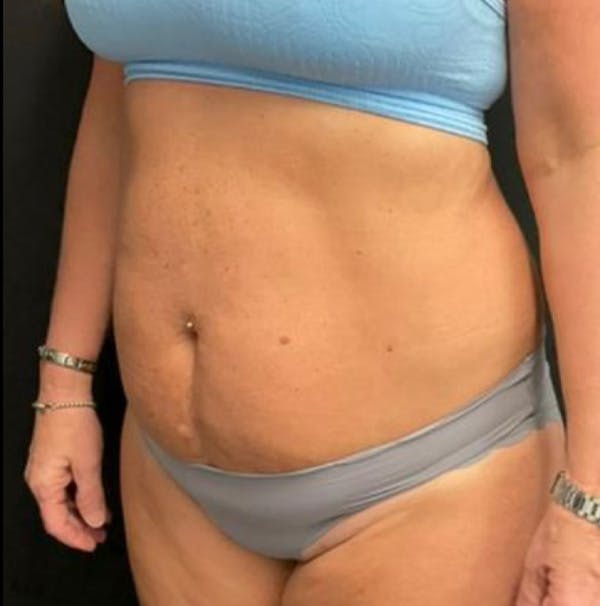Tummy Tuck Before & After Gallery - Patient 402666 - Image 5