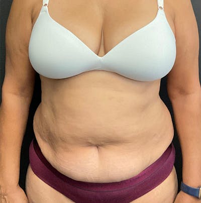 Tummy Tuck Before & After Gallery - Patient 357006 - Image 1