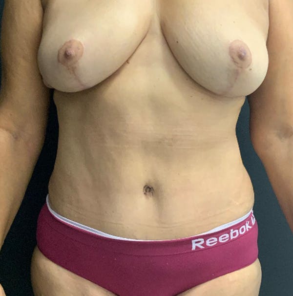 Tummy Tuck Before & After Gallery - Patient 357006 - Image 2
