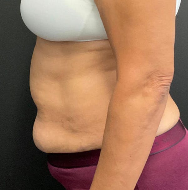 Tummy Tuck Before & After Gallery - Patient 357006 - Image 3