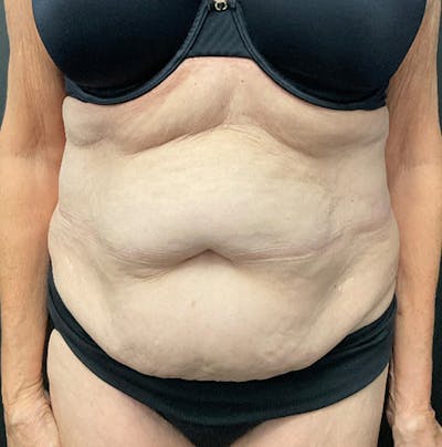 Tummy Tuck Before & After Gallery - Patient 383698 - Image 1