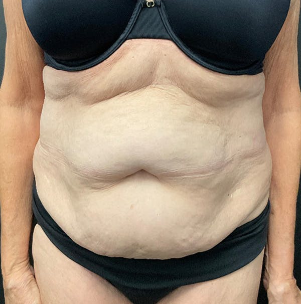 Tummy Tuck Before & After Gallery - Patient 383698 - Image 1