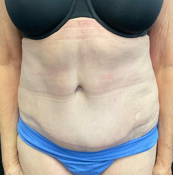 Tummy Tuck Before & After Gallery - Patient 383698 - Image 2