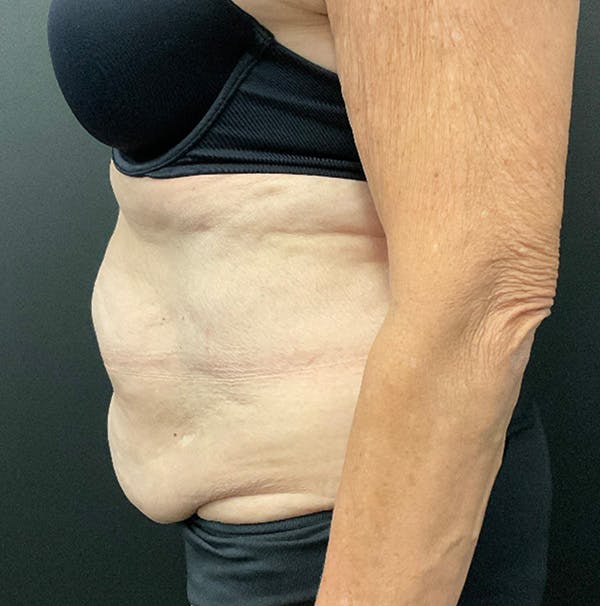 Tummy Tuck Before & After Gallery - Patient 383698 - Image 5