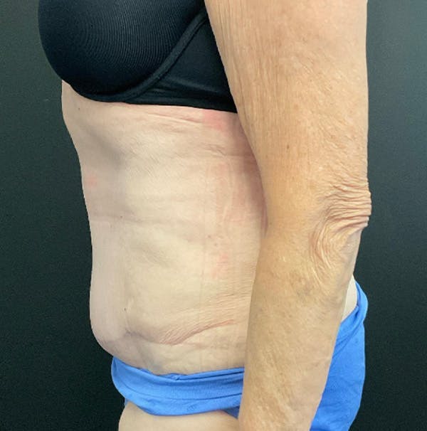 Tummy Tuck Before & After Gallery - Patient 383698 - Image 6