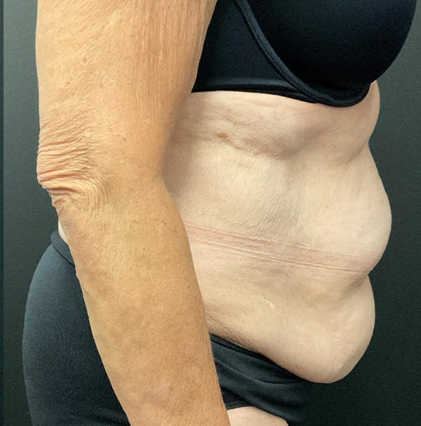 Tummy Tuck Before & After Gallery - Patient 383698 - Image 3