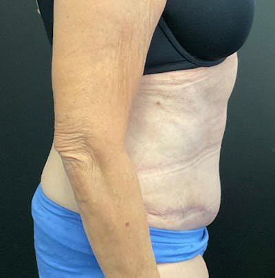 Tummy Tuck Before & After Gallery - Patient 383698 - Image 4