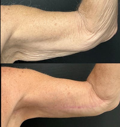 Brachioplasty Before & After Gallery - Patient 356597 - Image 1