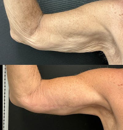 Brachioplasty Before & After Gallery - Patient 356597 - Image 2