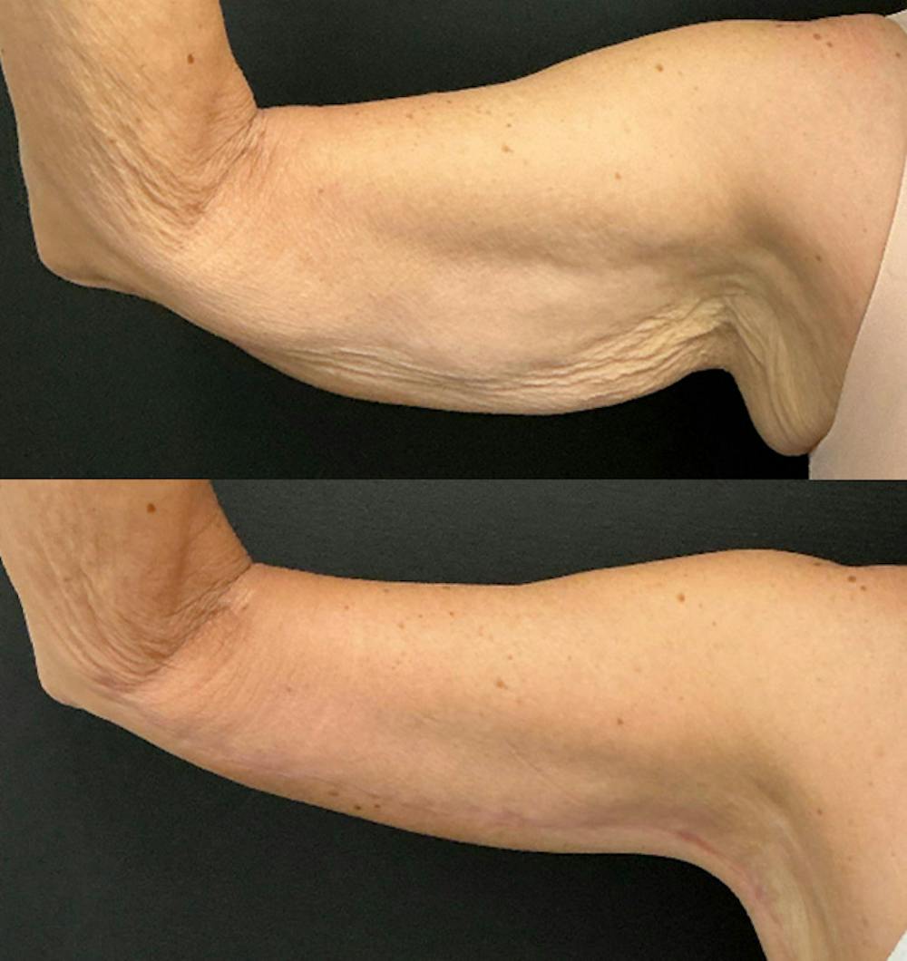 Brachioplasty Before & After Gallery - Patient 370010 - Image 3
