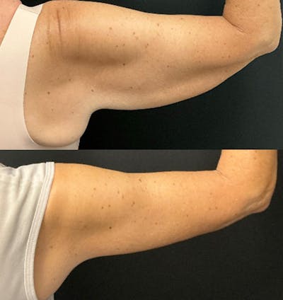Brachioplasty Before & After Gallery - Patient 370010 - Image 2