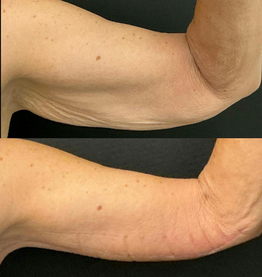 Brachioplasty Before & After Gallery - Patient 370010 - Image 1