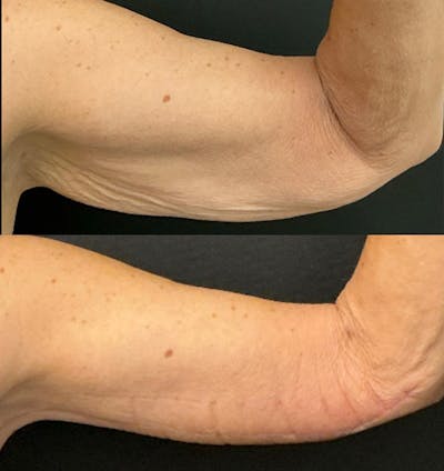 Brachioplasty Before & After Gallery - Patient 370010 - Image 1