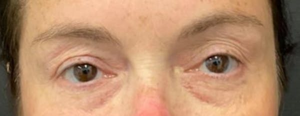 Blepharoplasty Before & After Gallery - Patient 262457 - Image 1