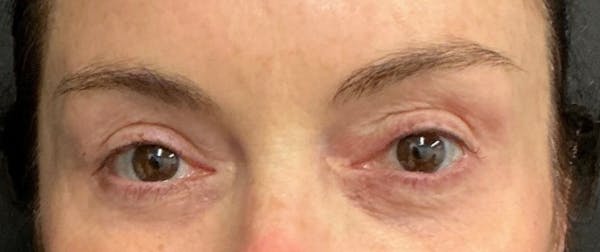 Blepharoplasty Before & After Gallery - Patient 262457 - Image 2