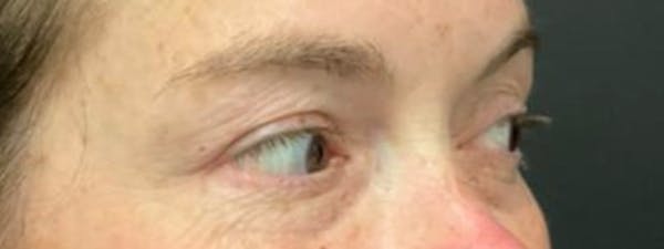 Blepharoplasty Before & After Gallery - Patient 262457 - Image 3