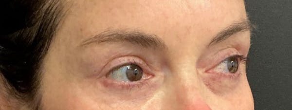 Blepharoplasty Before & After Gallery - Patient 262457 - Image 4