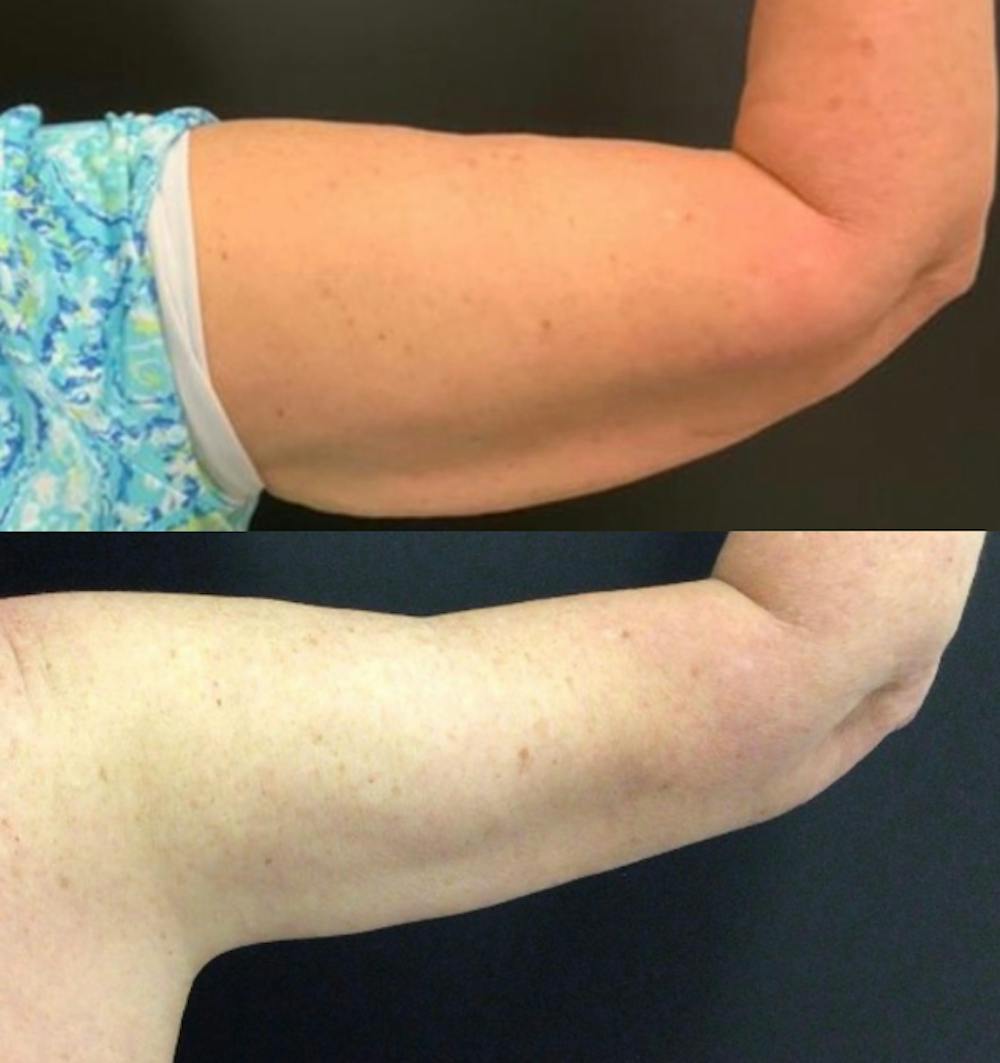 Brachioplasty Before & After Gallery - Patient 422840 - Image 2