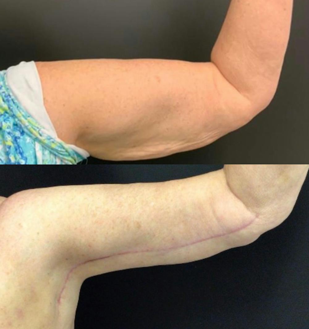 Brachioplasty Before & After Gallery - Patient 422840 - Image 1