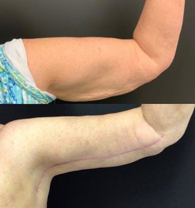 Brachioplasty Before & After Gallery - Patient 422840 - Image 1