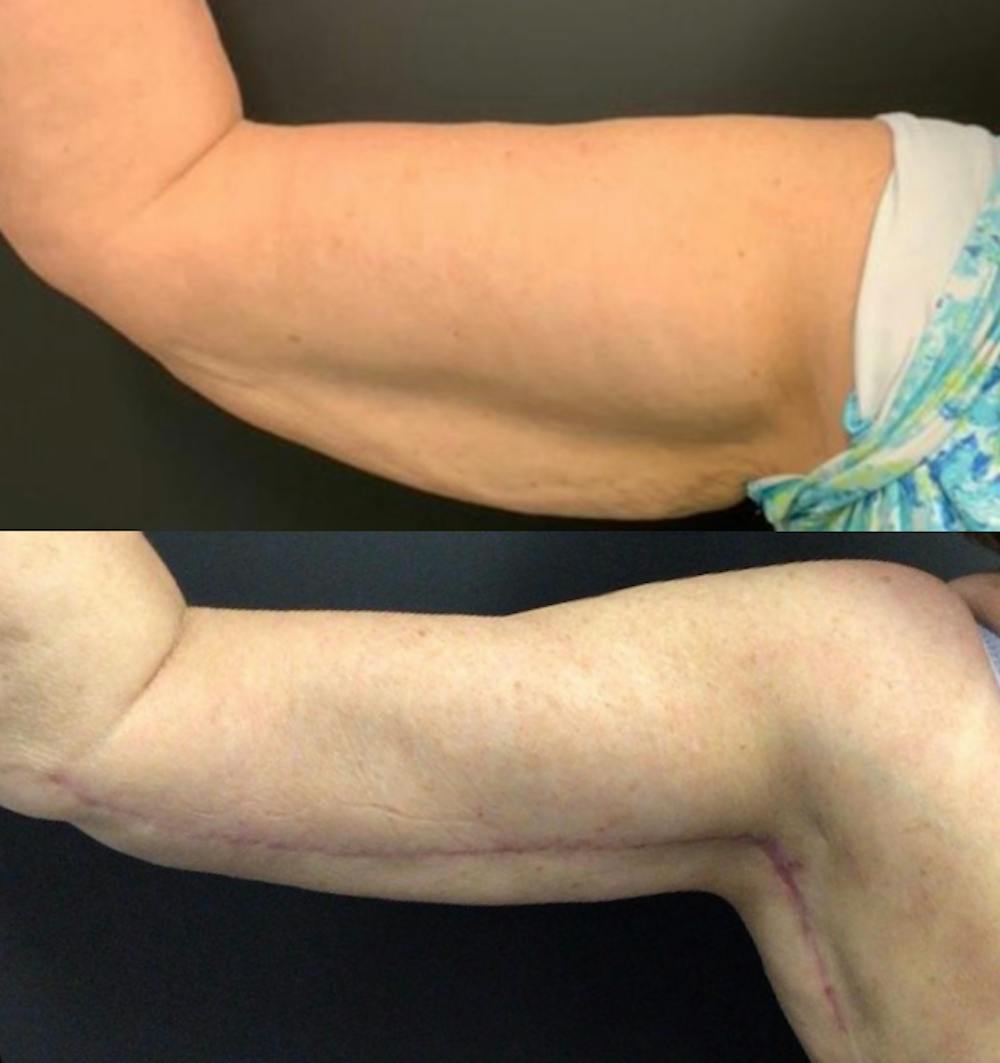 Brachioplasty Before & After Gallery - Patient 422840 - Image 3