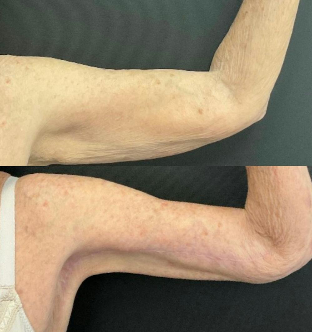 Brachioplasty Before & After Gallery - Patient 233241 - Image 1