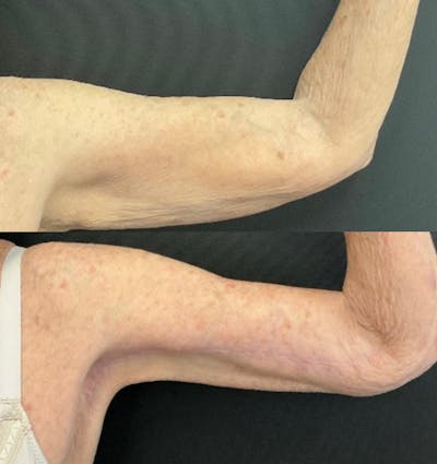 Brachioplasty Before & After Gallery - Patient 233241 - Image 1