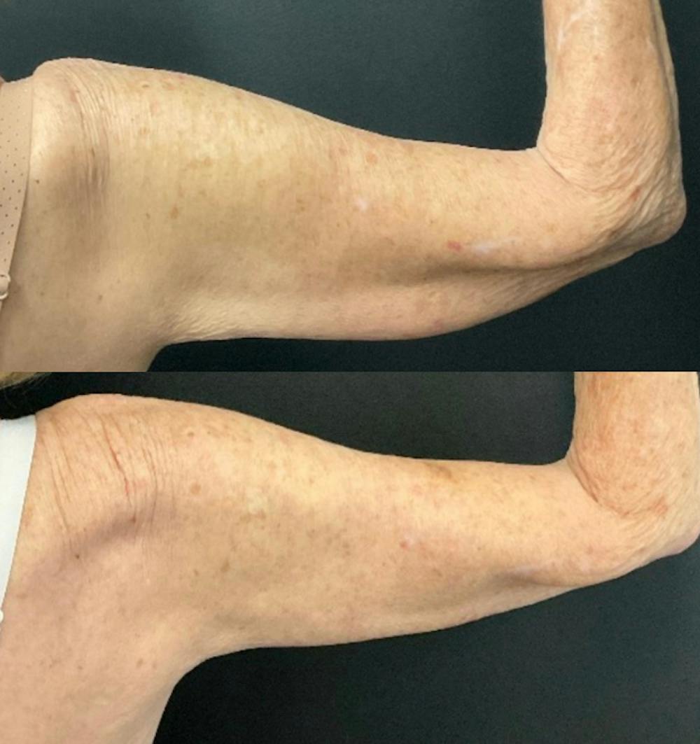 Brachioplasty Before & After Gallery - Patient 233241 - Image 2