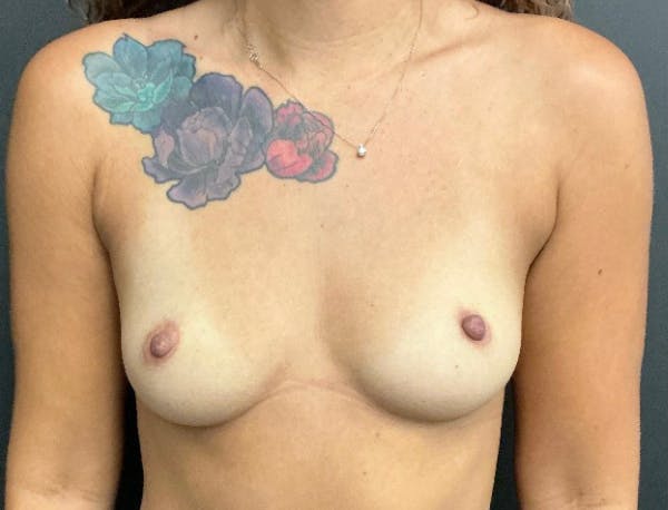 Breast Augmentation Before & After Gallery - Patient 661601 - Image 1
