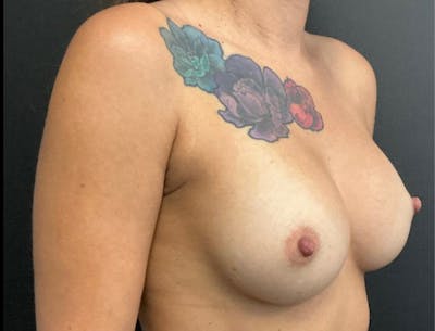 Breast Augmentation Before & After Gallery - Patient 661601 - Image 4