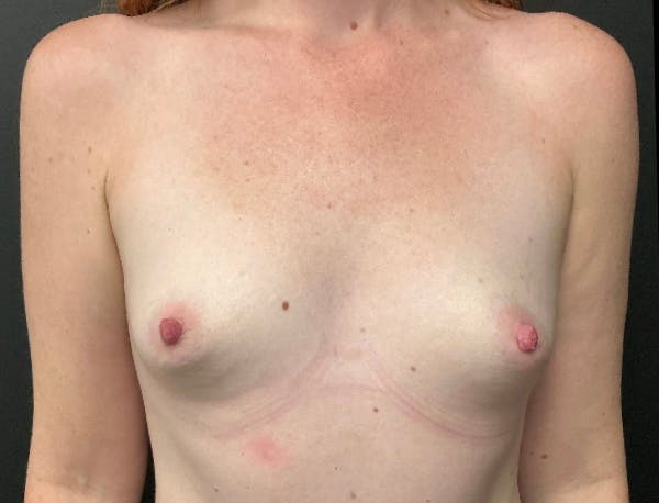 Breast Augmentation Before & After Gallery - Patient 240451 - Image 1