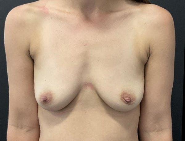 Breast Augmentation Before & After Gallery - Patient 385436 - Image 1