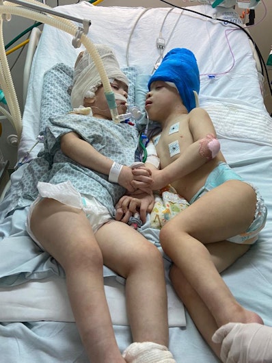 Frații siamezi din Brazilia, internați în spital