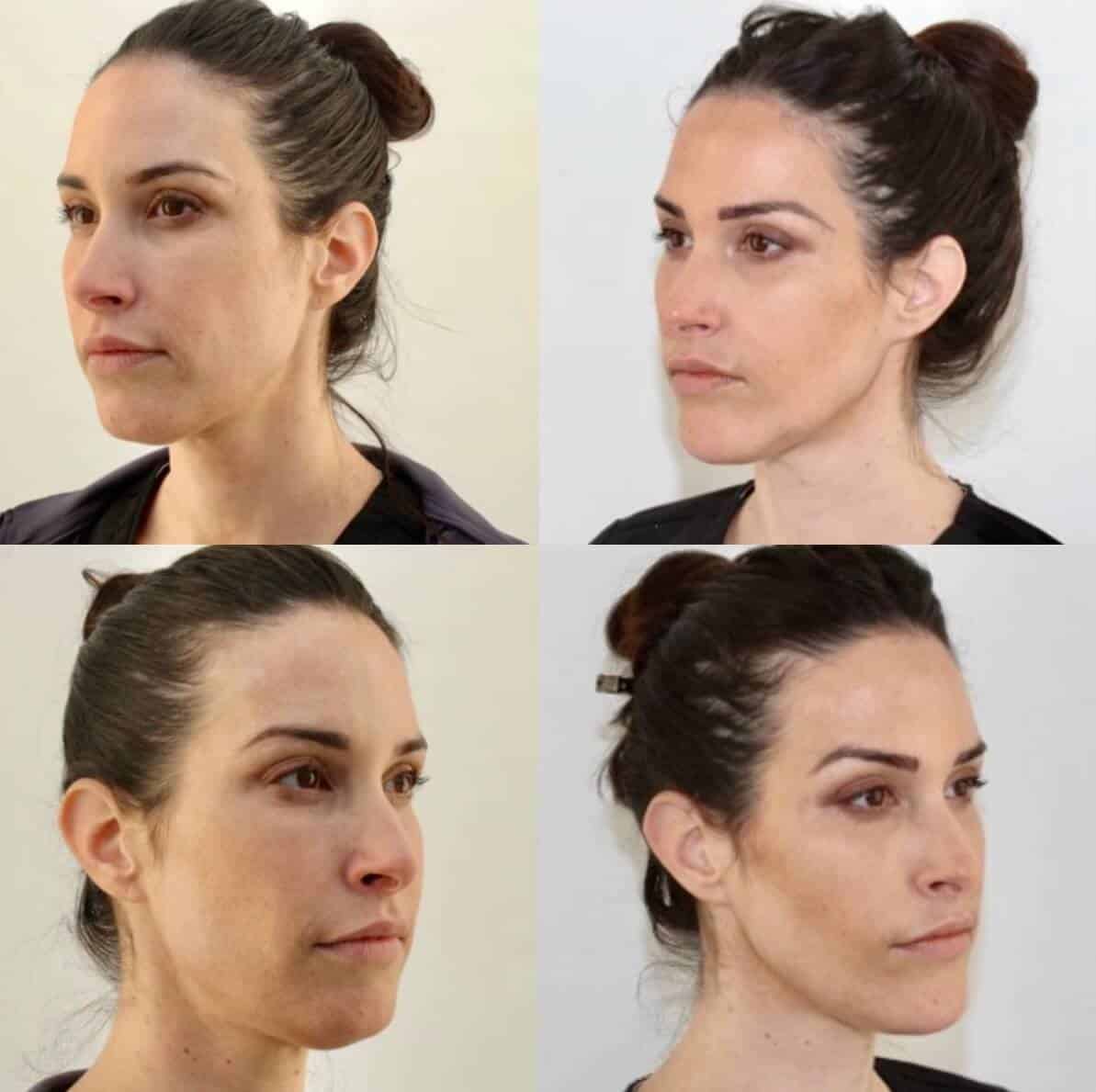 Before and After of FaceTite Patient in NYC